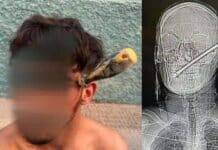Albatera: Street Fight Ends with Screwdriver Buried in Man’s Skull In a tense race against time, police took the crucial decision not to remove the screwdriver, fearing it could trigger catastrophic bleeding or cause even more severe brain damage. Instead, they stabilised the object and kept the victim under close watch until paramedics reached the scene.