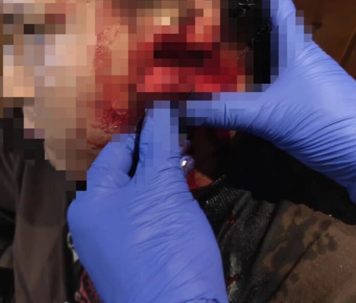 Une enquête policière a été ouverte après qu'une personne a été grièvement blessée par une bouteille lors d'une bagarre il y a plusieurs nuits.